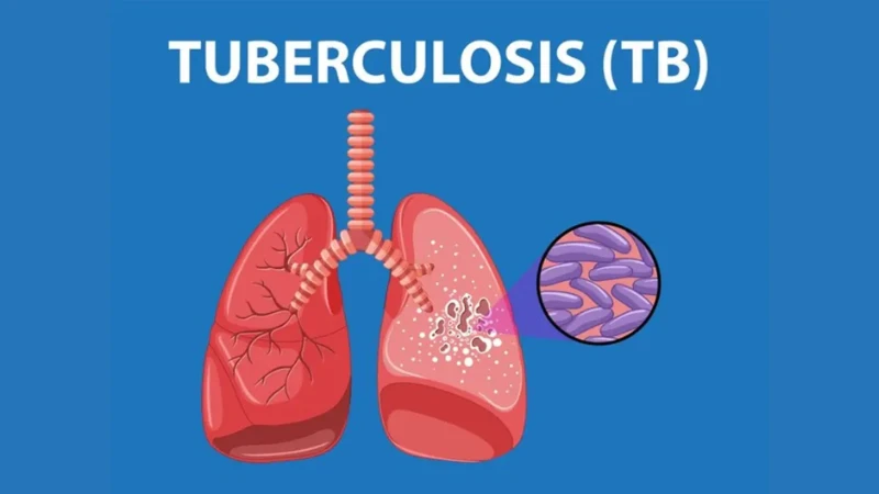Tuberculosis (TB) diagnosis.